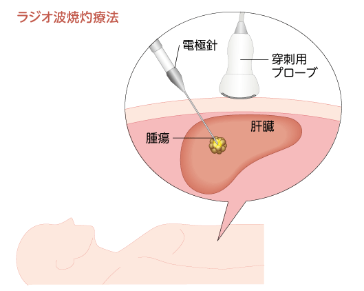ラジオ波焼灼療法