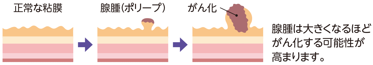 腺腫から発生したもの