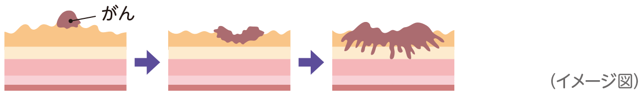 大腸がんの発生経路