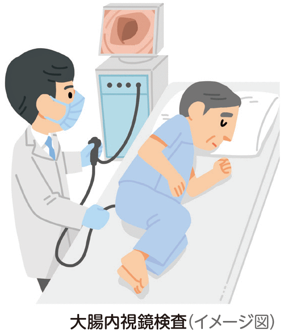 大腸内視鏡検査