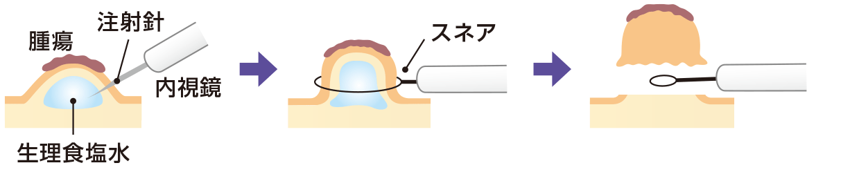 内視鏡的粘膜切除術（EMR）