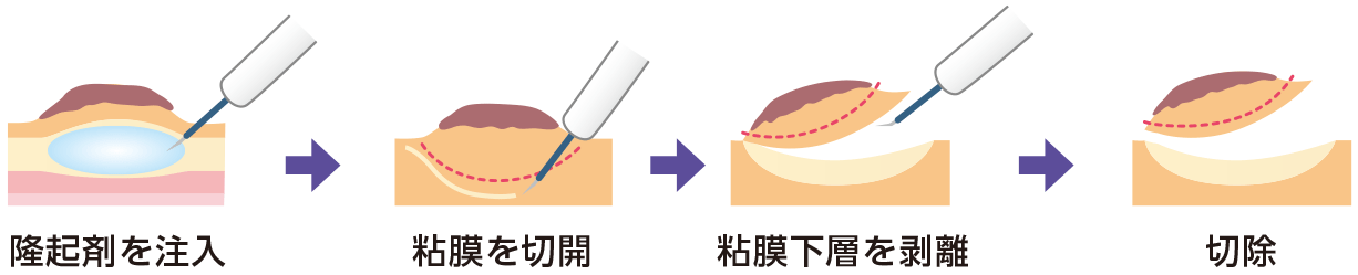 内視鏡的粘膜下層剥離術（ESD）