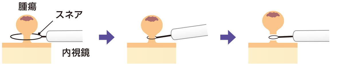 ポリペクトミー