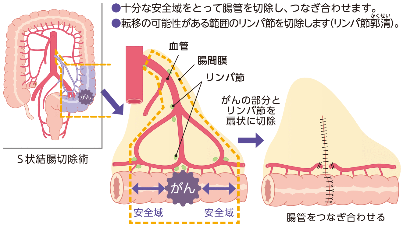 結腸がんの手術（例）