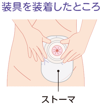 装具を装着したところ