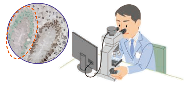MMRに関連するタンパク質の発現がなくなっている場合、dMMRと判定