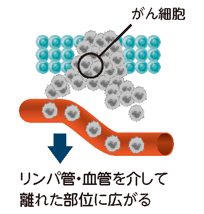 がんの転移と原発不明がん