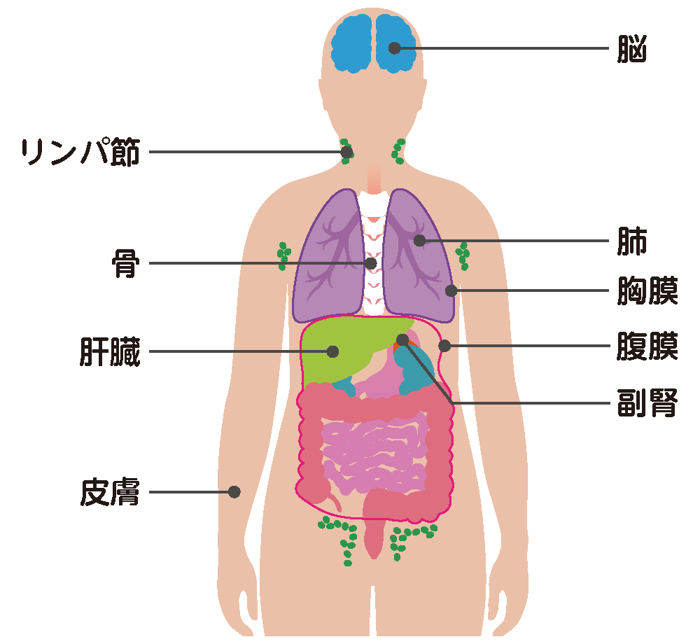 原発不明がんが見つかる部位