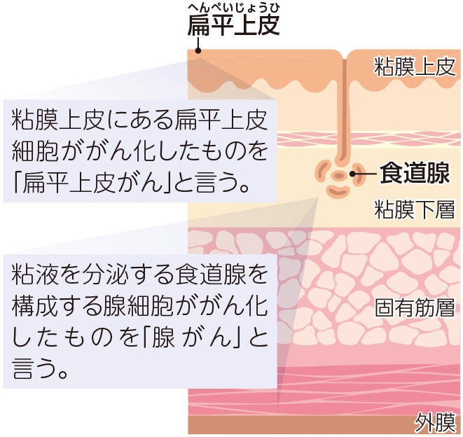 食道がんの種類