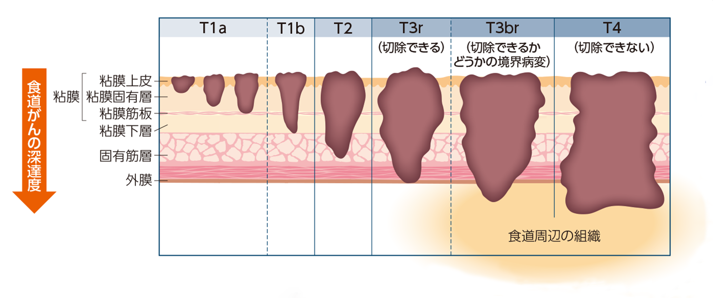 食道がんのT分類（深達度）