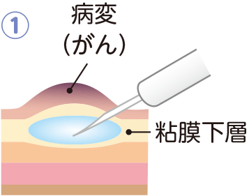 病変の下の粘膜下層へ生理食塩水などを注入し、がんを浮きあがらせます。