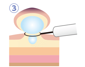 ワイヤーを少しずつしっかりと締めて、高周波電流を用いて切除します。