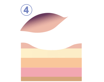 切除終了後は出血や切除した状態を観察します。