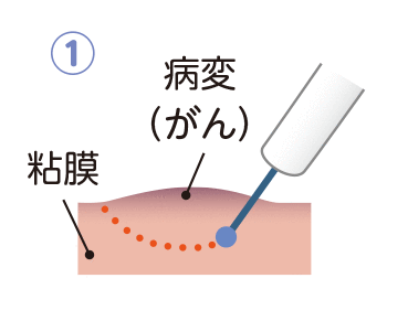 病変のまわりに切除する範囲の目印をつけるマーキングを行います。