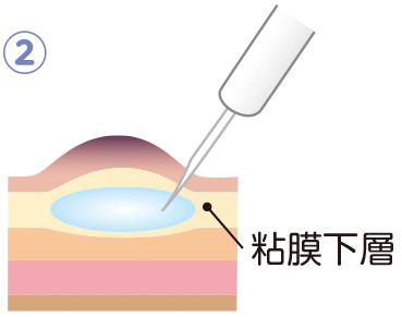 病変の下の粘膜下層へ生理食塩水やヒアルロン酸ナトリウムなどを注入し、がんを浮きあがらせます。