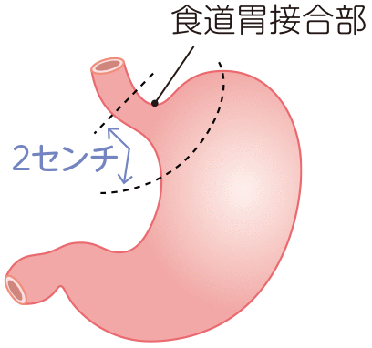 腹部食道がんの手術