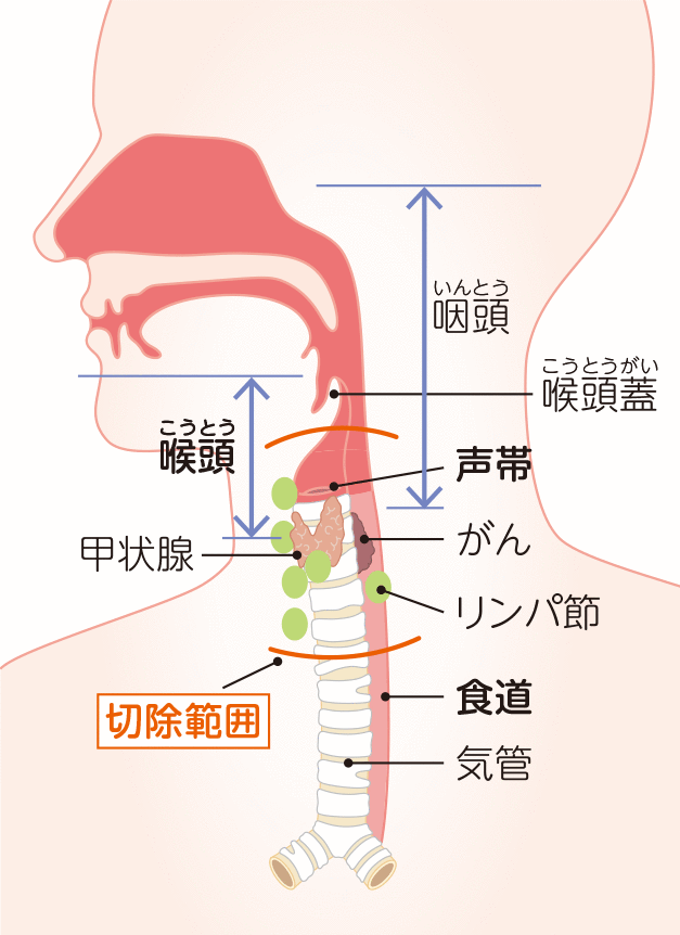 喉頭を切除する場合