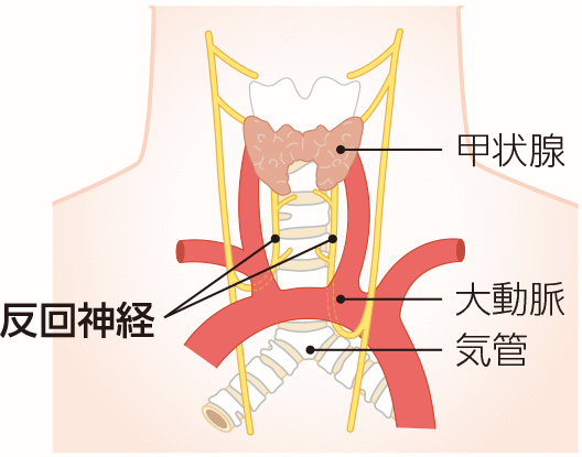 反回神経マヒ
