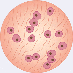 未分化型胃がん