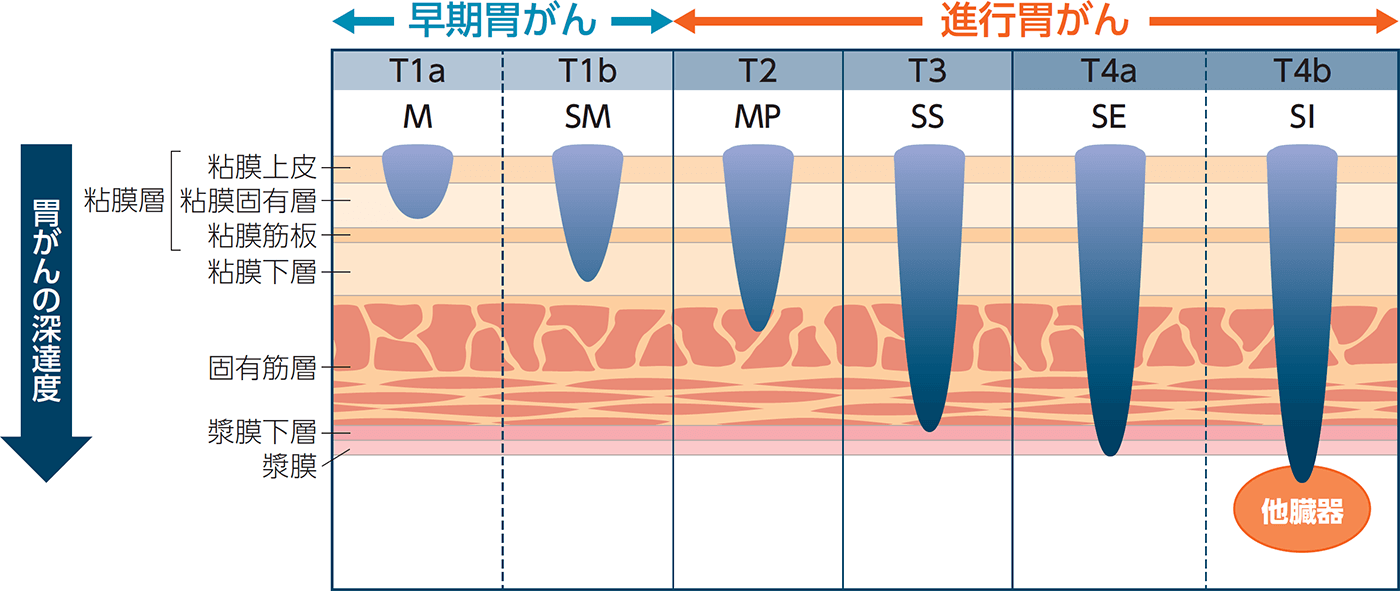 胃がんの深達度