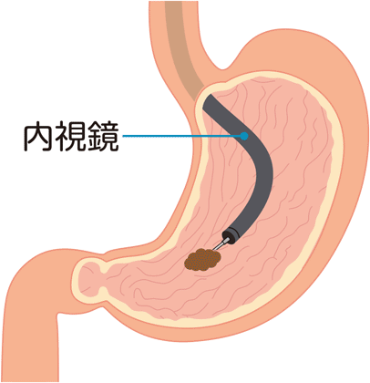 内視鏡的粘膜下層剥離術