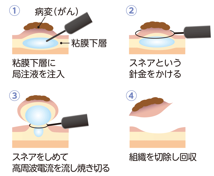 内視鏡的粘膜切除術
