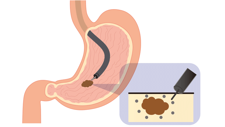 内視鏡的粘膜下層剥離術