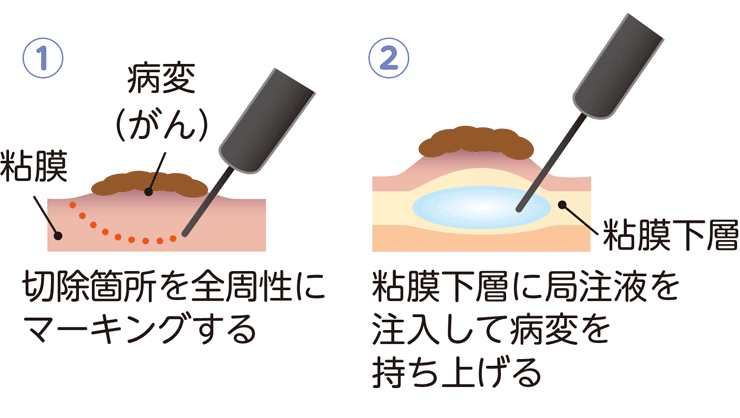 内視鏡的粘膜下層剥離術
