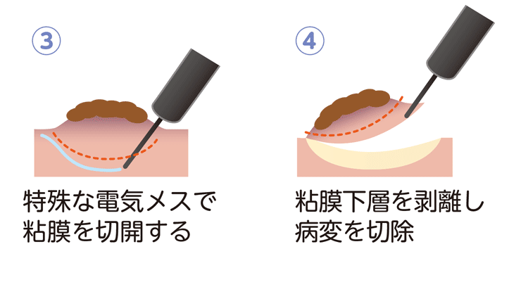 内視鏡的粘膜下層剥離術