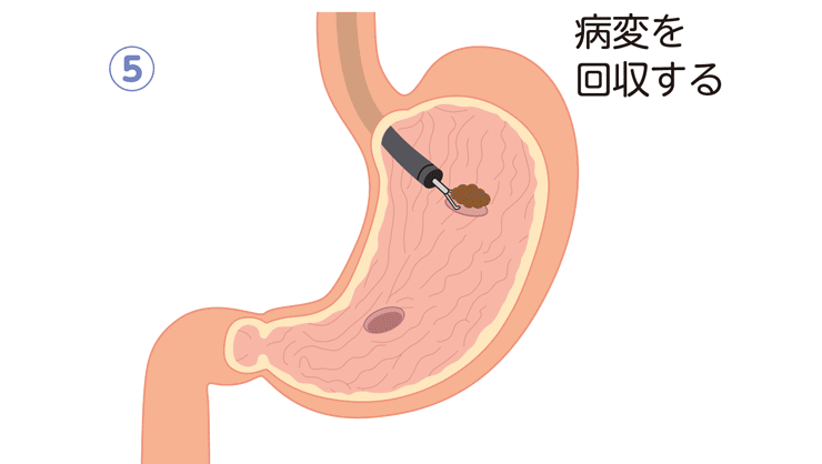 内視鏡的粘膜下層剥離術