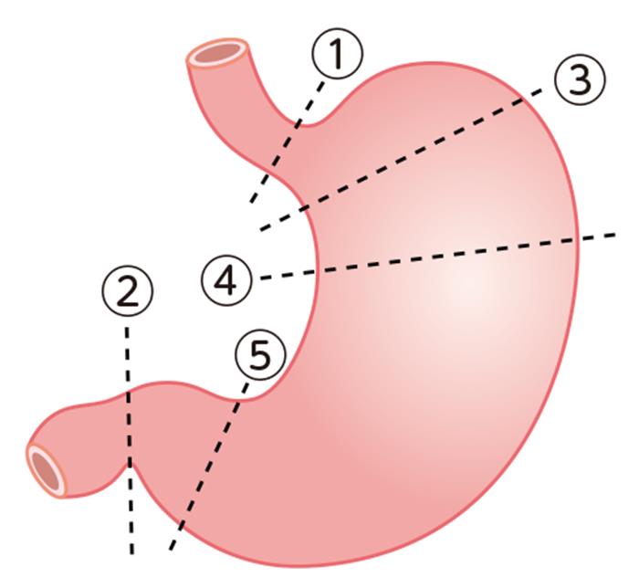 胃の切除箇所