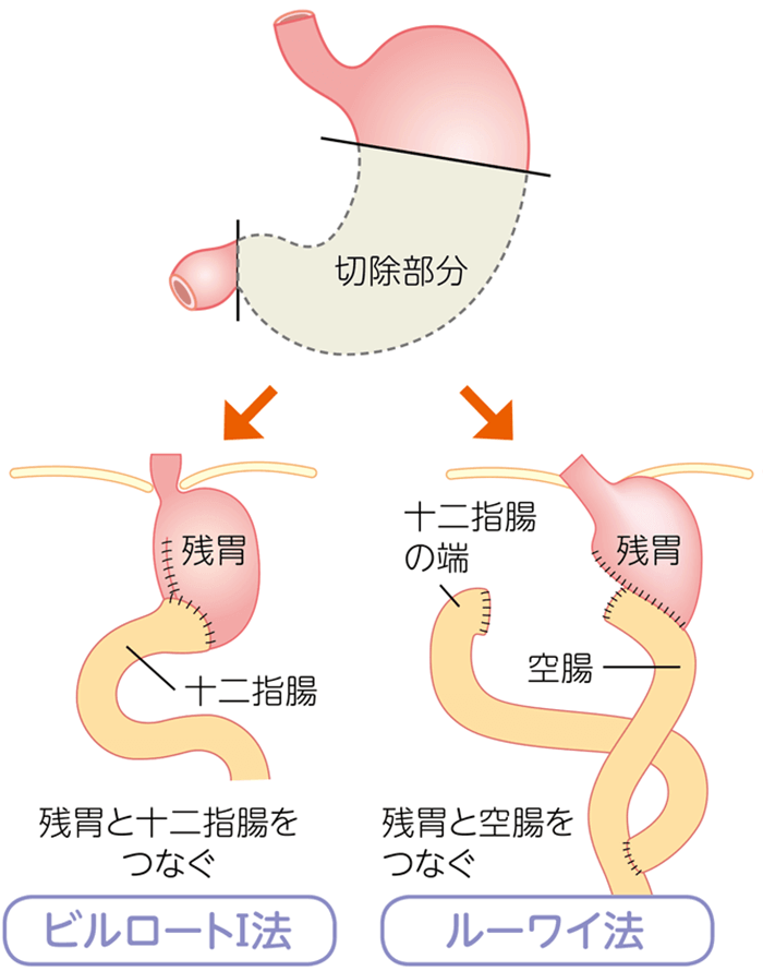 幽門側胃切除術