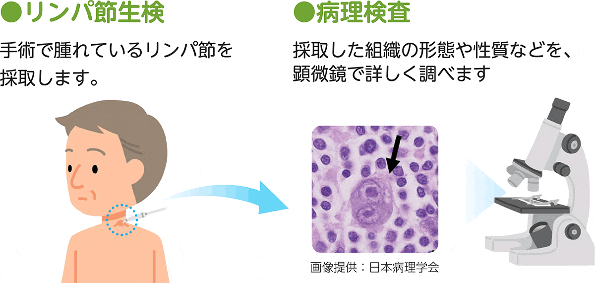 リンパ節生検と病理検査の図リンパ節生検では手術で腫れているリンパ節を採取し、そこから病理検査として採取した組織の形態や性質などを顕微鏡で詳しく調べます。