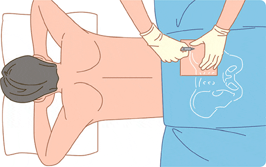 骨髄検査のイラスト