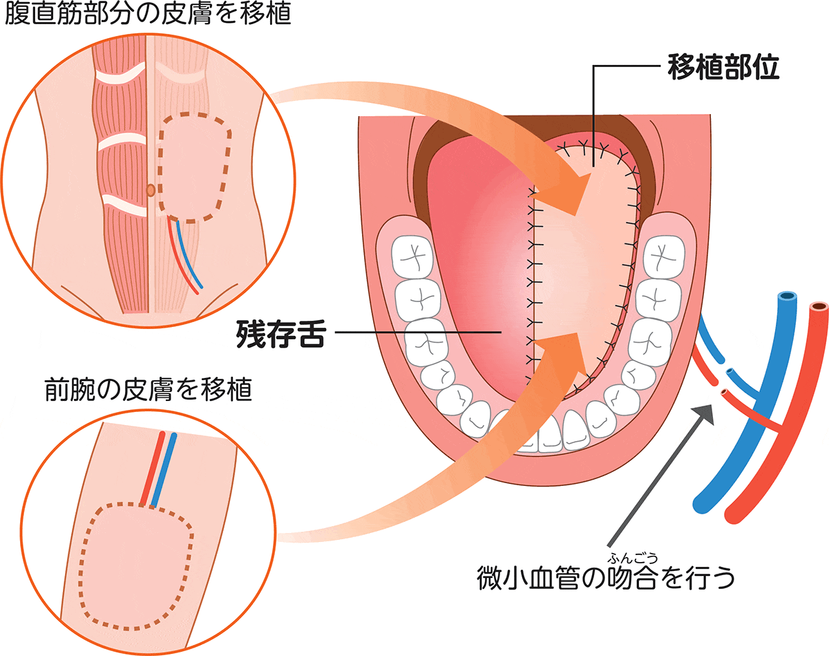 舌がんの再建術