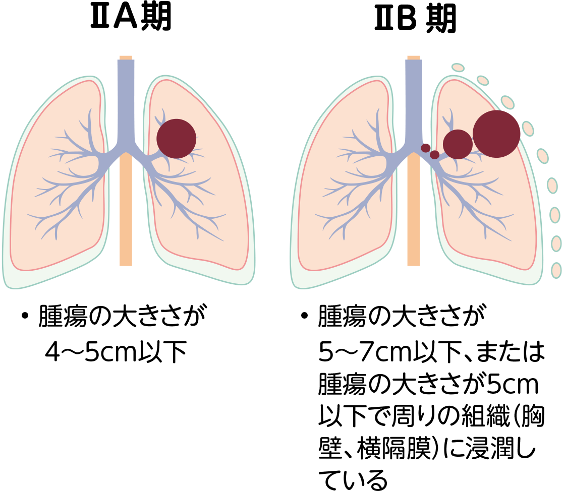 非小細胞肺がんの病期ⅡＡ期とⅡB期の図。ⅡＡ期は腫瘍の大きさが4〜5cm以下。ⅡB期は腫瘍の大きさが5〜7cm以下、または腫瘍の大きさが5cm以下で周りの組織（胸壁、横隔膜）に浸潤している。