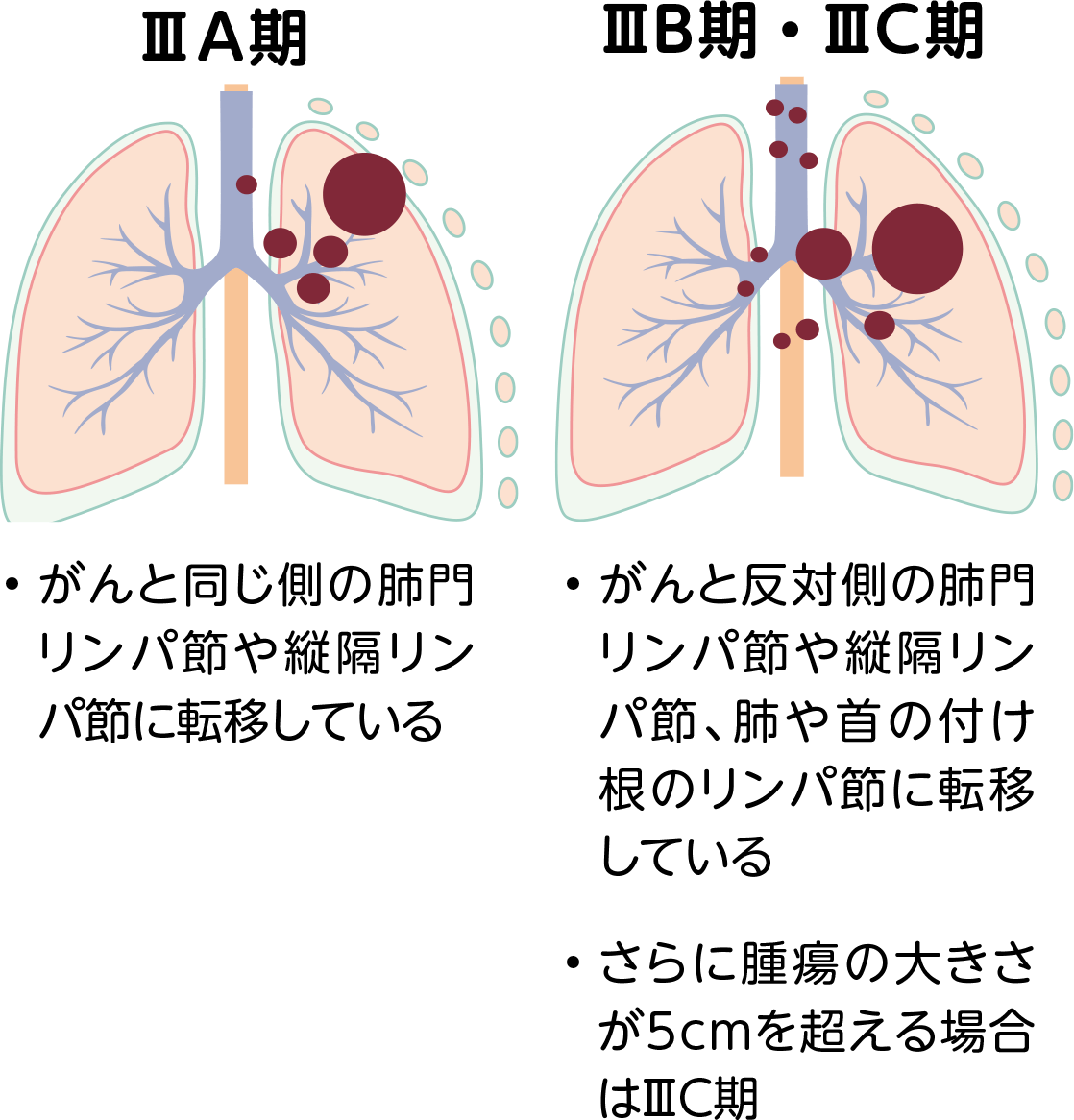 非小細胞肺がんの病期ⅢＡ期とⅢB期の図。ⅢＡ期は横隔膜、胸壁、心臓、大血管、気管、食道などに浸潤しており、がんと同じ側の肺門リンパ節や縦隔リンパ節に転移している。ⅢB期は横隔膜、胸壁、心臓、大血管、気管、食道などに浸潤しており、がんと反対側の肺門リンパ節や縦隔リンパ節、肺や首の付け根のリンパ節に転移している。