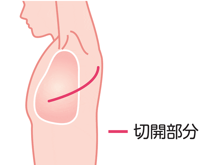 肺がんにおける開胸手術の図