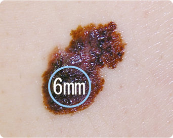 悪性黒色腫の特徴である大型の病変の写真