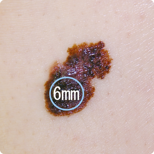 悪性黒色腫の特徴である大型の病変の写真