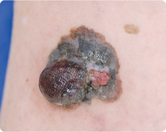 悪性黒色腫の特徴である多彩な色調の写真