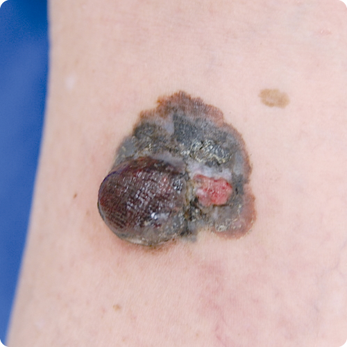 悪性黒色腫の特徴である多彩な色調の写真