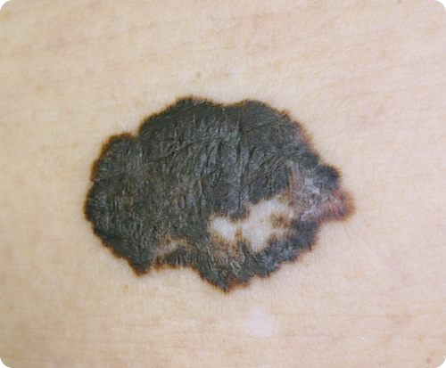 表在拡大型黒色腫の症状の写真