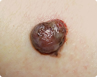 結節型黒色腫の症状の写真