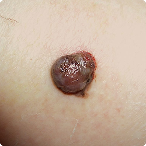 結節型黒色腫の症状の写真