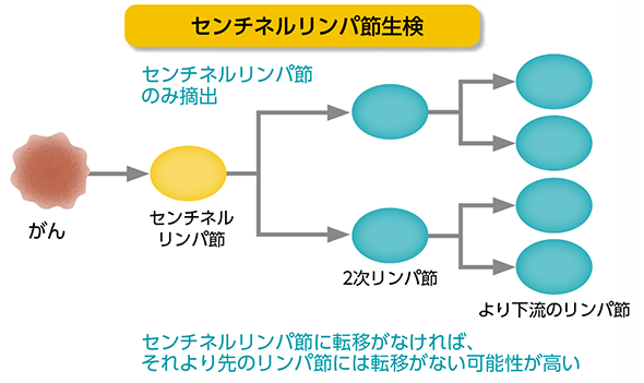 センチネルリンパ節に転移がなければ、それより先のリンパ節には転移はないはず。
