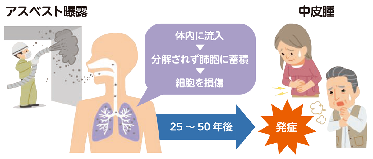 アスベスト曝露と中皮腫の発症