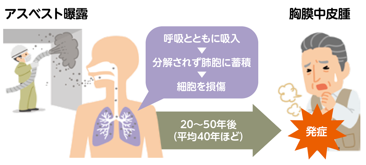 アスベスト曝露と胸膜中皮腫の発症