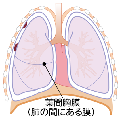 胸膜中皮腫の病期 Ⅰ期の図