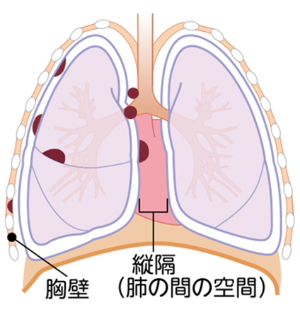 胸膜中皮腫の病期 Ⅱ期の図